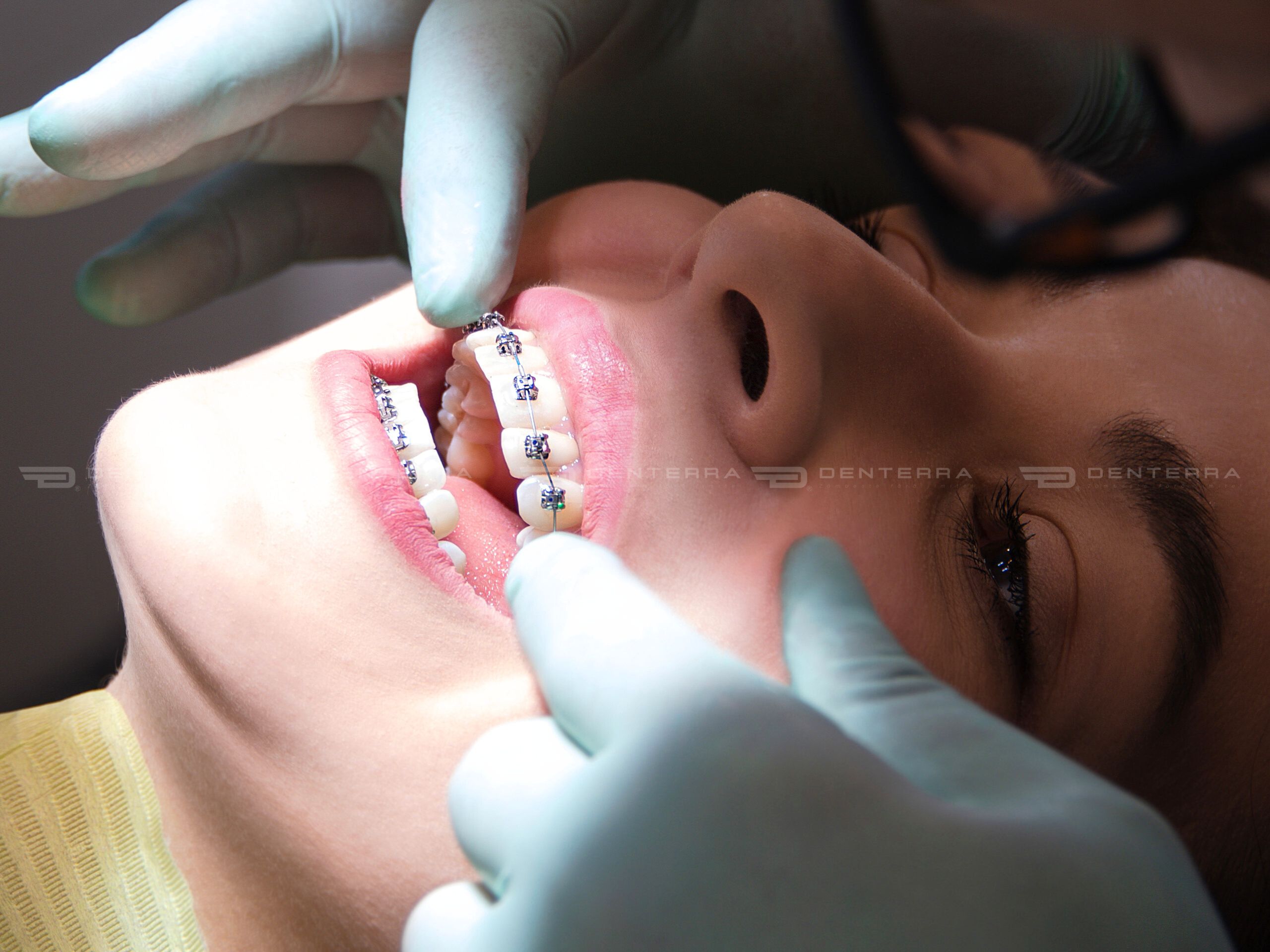 Aparat-Dentar-DenterraClinic-Brașov