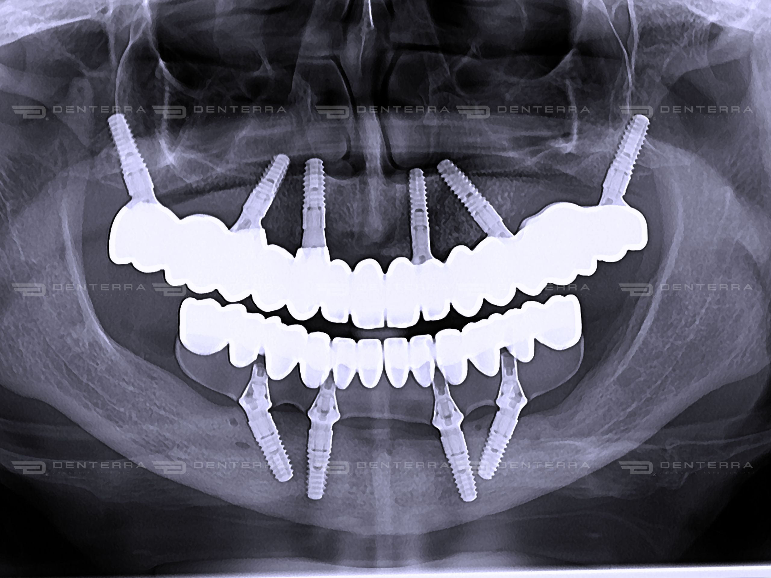 Radiolografie-Dentară-DenterraClinic-Brașov